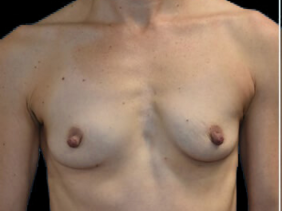 Breast Augmentation Case 11 - Before