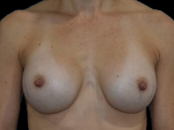 Breast Augmentation Case 11 - After