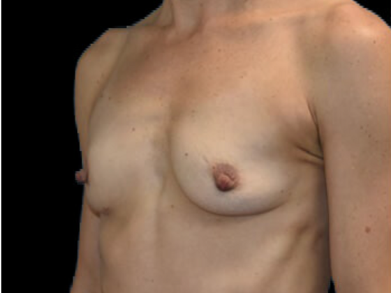 Breast Augmentation: Case 11 - Before