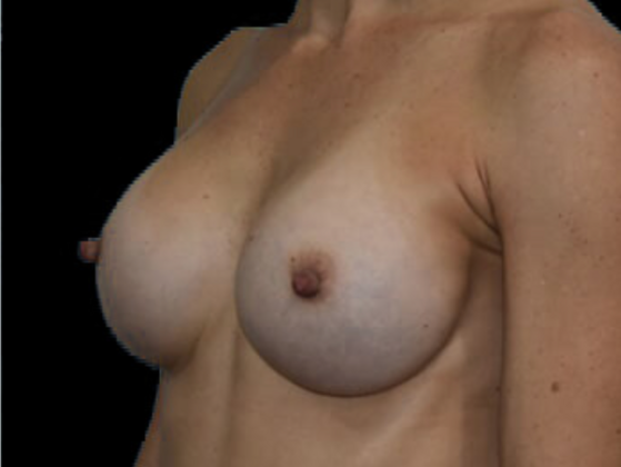 Breast Augmentation: Case 11 - After