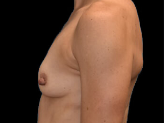 Breast Augmentation: Case 11 - Before