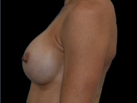 Breast Augmentation: Case 11 - After