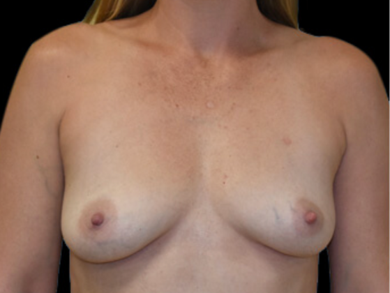 Breast Augmentation: Case 12 - Before