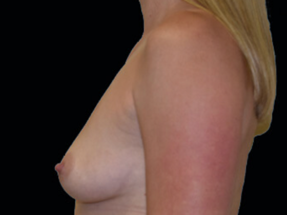 Breast Augmentation: Case 12 - After