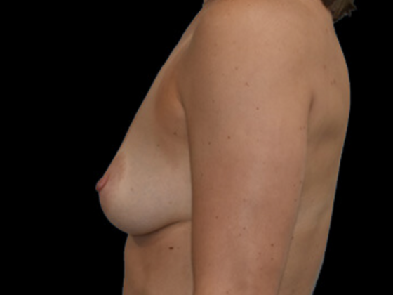Breast Augmentation: Case 13 - Before