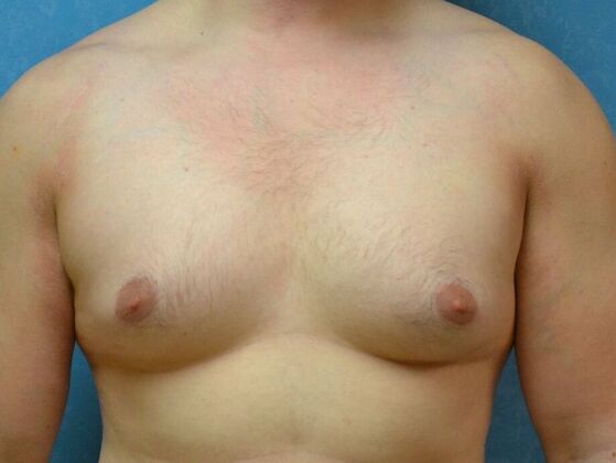Gynecomastia Case 1516- Sylvania, OH - Before