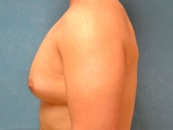 Gynecomastia: Case 1516- Sylvania, OH - Before