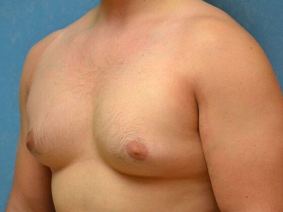 Gynecomastia: Case 1516- Sylvania, OH - Before