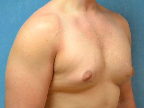 Gynecomastia: Case 1516- Sylvania, OH - Before