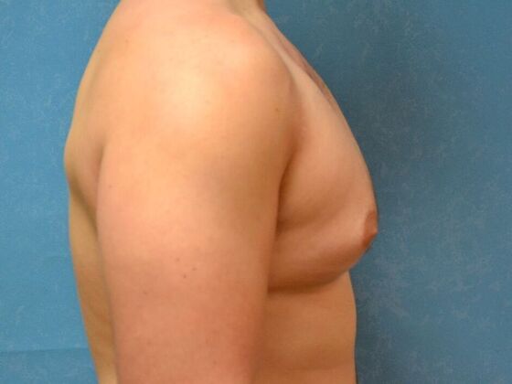 Gynecomastia: Case 1516- Sylvania, OH - Before