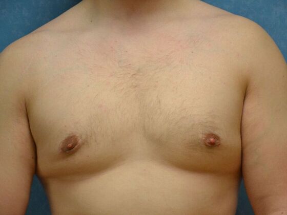 Gynecomastia Case 1516- Sylvania, OH - After