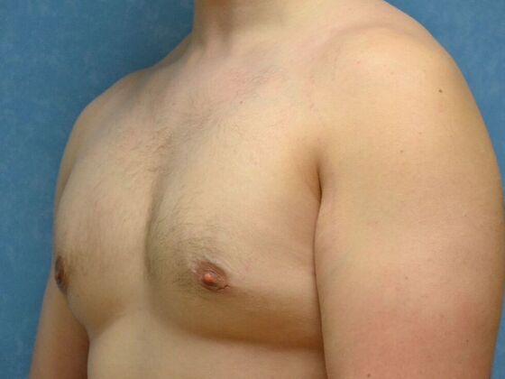Gynecomastia: Case 1516- Sylvania, OH - After