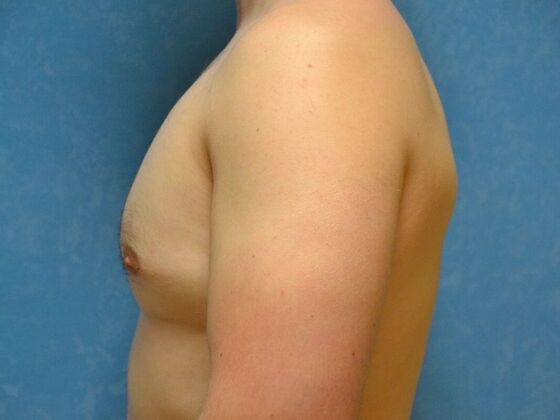 Gynecomastia: Case 1516- Sylvania, OH - After