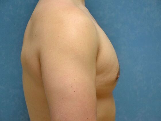 Gynecomastia: Case 1516- Sylvania, OH - After
