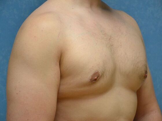 Gynecomastia: Case 1516- Sylvania, OH - After