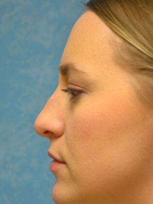 Rhinoplasty: Case 1736- Monclova, OH - Before