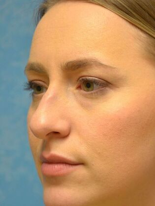 Rhinoplasty: Case 1736- Monclova, OH - Before