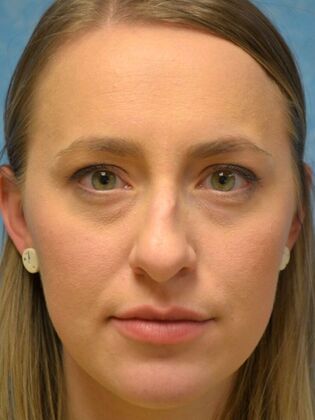 Rhinoplasty Case 1736- Monclova, OH - Before