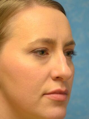 Rhinoplasty: Case 1736- Monclova, OH - Before