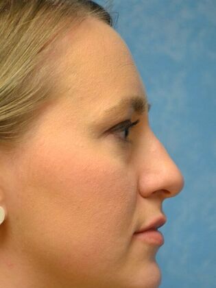 Rhinoplasty: Case 1736- Monclova, OH - Before