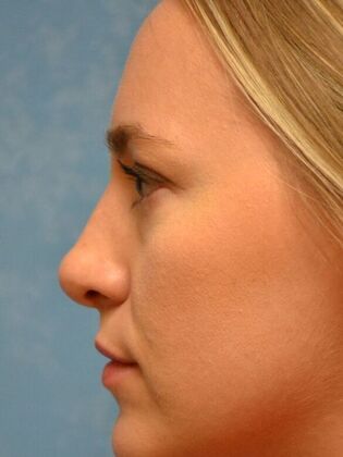 Rhinoplasty: Case 1736- Monclova, OH - After