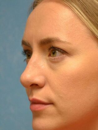 Rhinoplasty: Case 1736- Monclova, OH - After