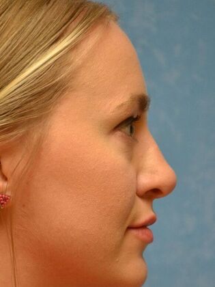 Rhinoplasty: Case 1736- Monclova, OH - After