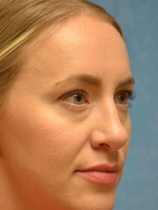 Rhinoplasty: Case 1736- Monclova, OH - After