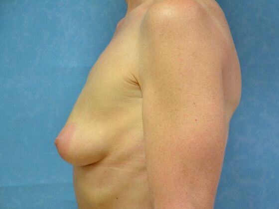 Breast Augmentation: Case 1767- Britton, MI - Before