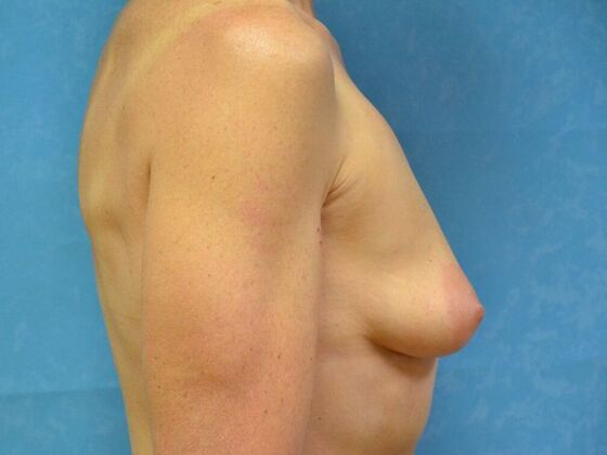 Breast Augmentation: Case 1767- Britton, MI - Before