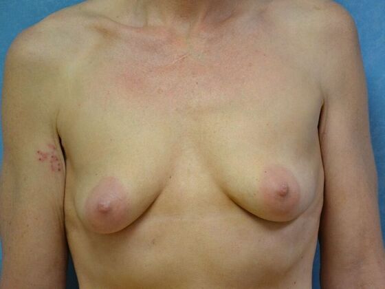 Breast Augmentation: Case 1767- Britton, MI - Before