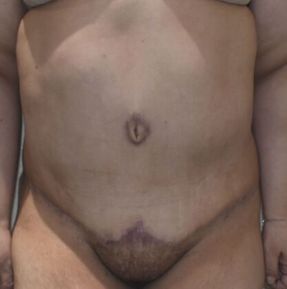 Tummy Tuck (Abdominoplasty): Case 455 - After