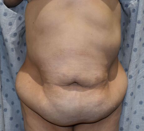 Massive Weight Loss : Case 142 - Before