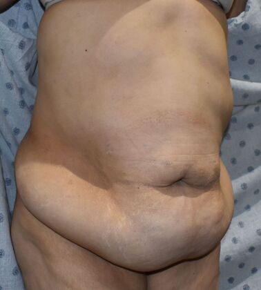 Massive Weight Loss : Case 142 - Before
