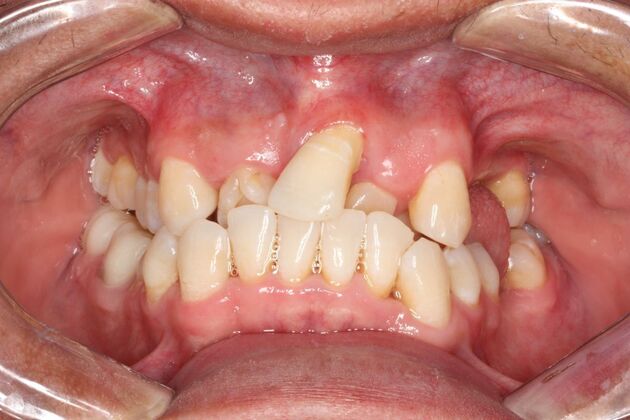 Porcelain Crowns and Veneers: Case 11 - Before