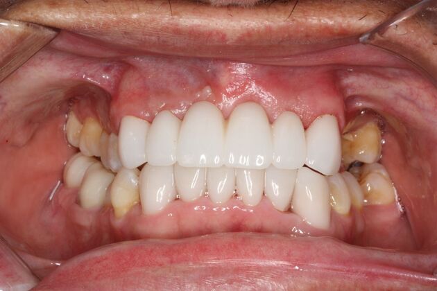 Porcelain Crowns and Veneers: Case 11 - After