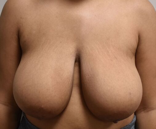 Breast Reduction: Case 171 - Before