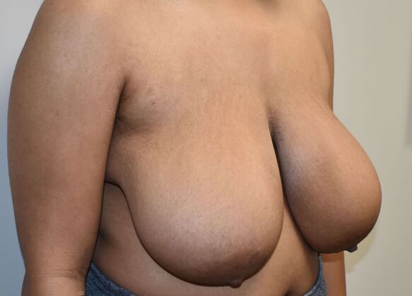 Breast Reduction: Case 171 - Before