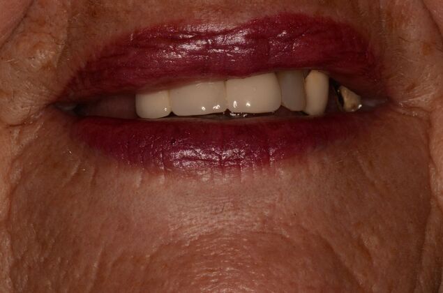 Dental Implants Case 60 - Before