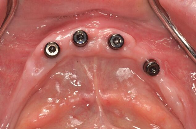 Dental Implants: Case 60 - Lower teeth replaced with four implants