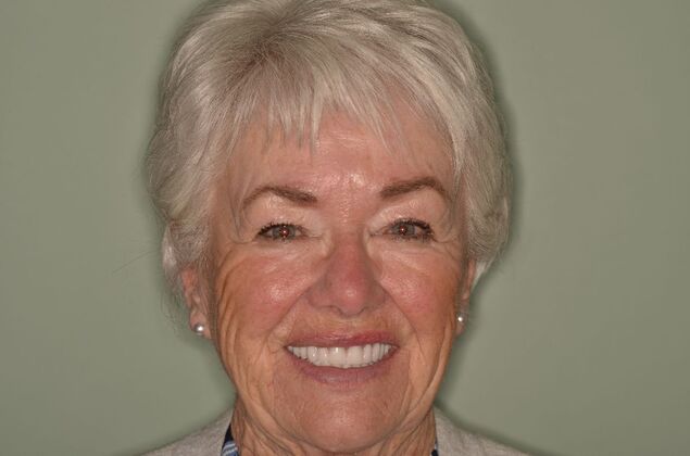 Dental Implants: Case 60 - After smile with implant supported dentures. 