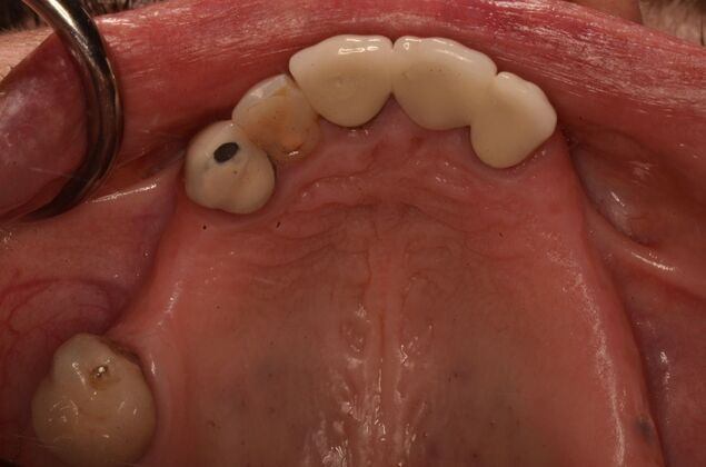 Dentures: Case 1 - Before with upper failing dentition and restorations