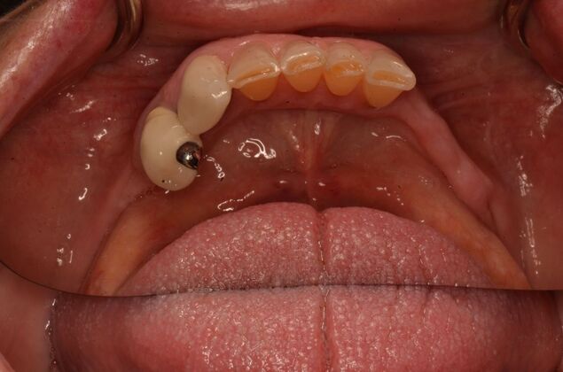 Dentures: Case 1 - Before with natural failing dentition
