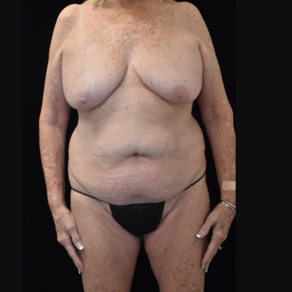 Mommy Makeover Case 6 - Before