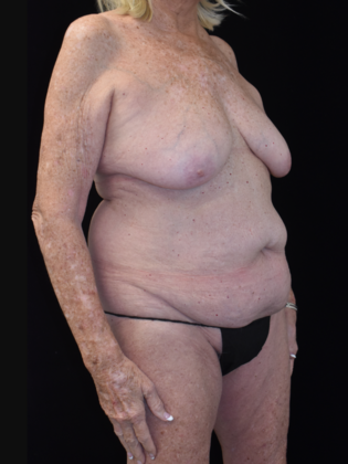 Mommy Makeover: Case 6 - Before