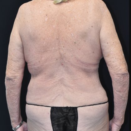 Mommy Makeover: Case 6 - After