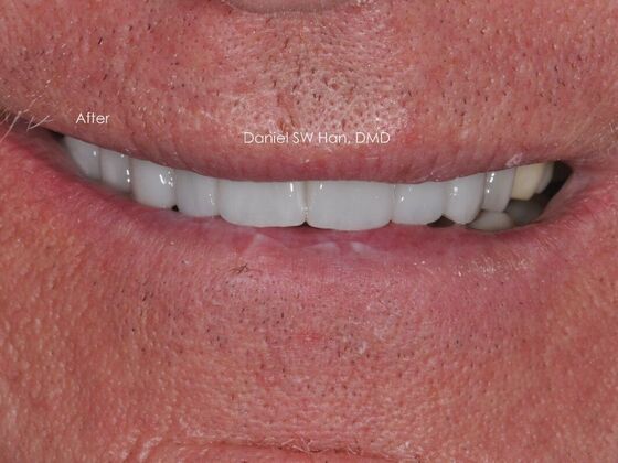 Cosmetic Dentistry: Case 9 - After