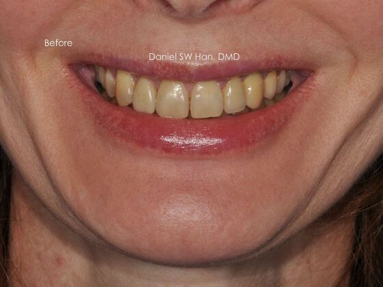 Cosmetic Dentistry: Case 10 - Before