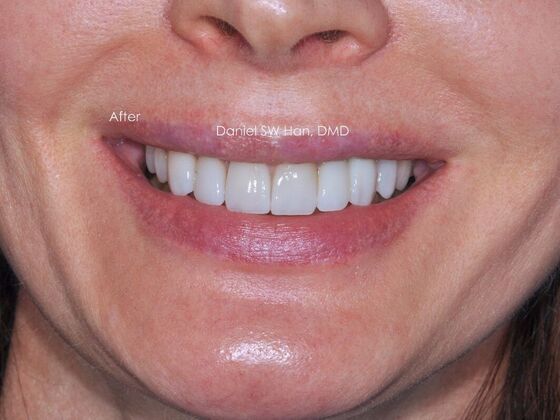 Cosmetic Dentistry: Case 10 - After