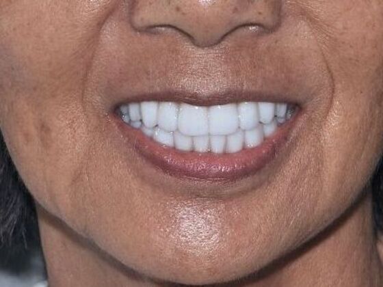 Cosmetic Dentistry: Case 11 - After